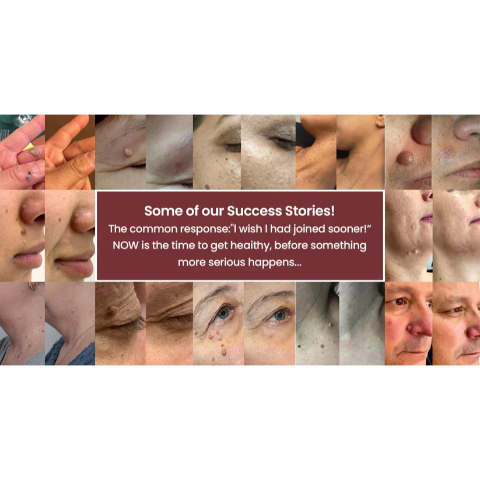 🌟 Curalona® 2-in-1 Microneedle & Hydrocolloid Patch 🌿 Invisible Face & Body Patches for Raised Moles, Acne, Flat Warts & Skin Tags - Helps Improve the Appearance of Wrinkles, Scars & Blemishes