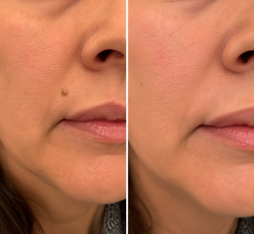 🌟 Curalona® 2-in-1 Microneedle & Hydrocolloid Patch 🌿 Invisible Face & Body Patches for Raised Moles, Acne, Flat Warts & Skin Tags - Helps Improve the Appearance of Wrinkles, Scars & Blemishes