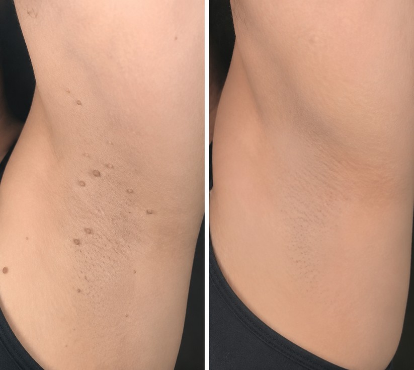 🌟 Curalona® 2-in-1 Microneedle & Hydrocolloid Patch 🌿 Invisible Face & Body Patches for Raised Moles, Acne, Flat Warts & Skin Tags - Helps Improve the Appearance of Wrinkles, Scars & Blemishes