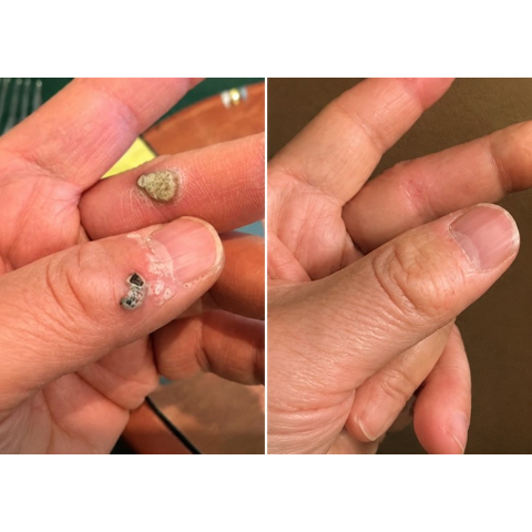 🌟 Curalona® 2-in-1 Microneedle & Hydrocolloid Patch 🌿 Invisible Face & Body Patches for Raised Moles, Acne, Flat Warts & Skin Tags - Helps Improve the Appearance of Wrinkles, Scars & Blemishes
