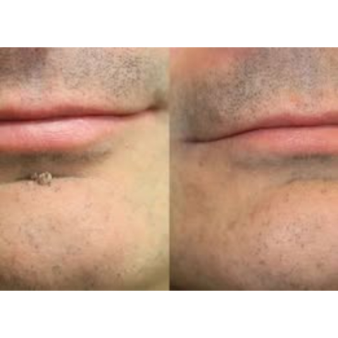🌟 Curalona® 2-in-1 Microneedle & Hydrocolloid Patch 🌿 Invisible Face & Body Patches for Raised Moles, Acne, Flat Warts & Skin Tags - Helps Improve the Appearance of Wrinkles, Scars & Blemishes